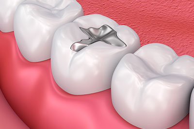 The image depicts a 3D rendering of an open mouth with a single silver-colored toothpick inside the upper right incisor, set against a red background that resembles a lipstick case.