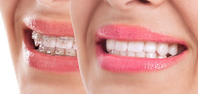 The image shows two close-up photographs of a person smiling with braces, displaying teeth whitening results.