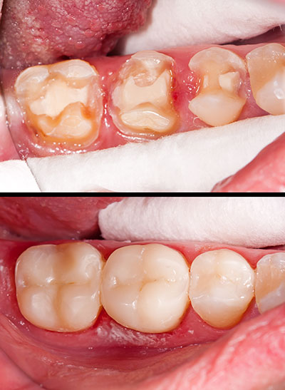 The image shows a close-up view of a dental procedure in progress, with a patient s mouth open revealing a tooth being worked on, and two panels showing different stages of the treatment.