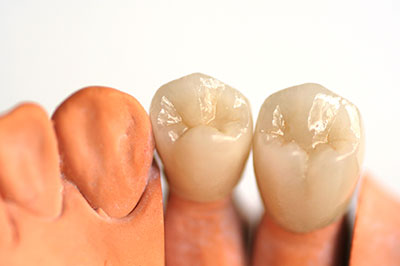 The image shows two artificial teeth placed side by side against a white background, with each tooth exhibiting a different level of wear and staining.