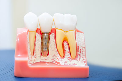 The image shows a dental model with artificial teeth and gums, featuring a tooth with an implant and another with a bridge, set against a blue background.