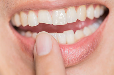 The image shows a close-up of a person s smiling mouth with teeth, revealing a dental implant on the upper right side.