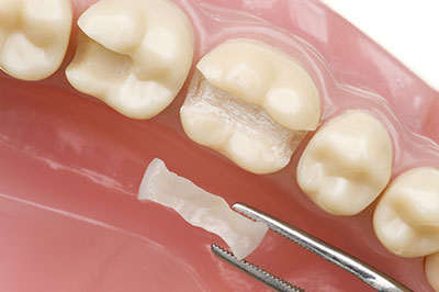 The image displays a close-up view of a dental implant with a screw visible on a model tooth, showcasing the surgical process for dental restoration.