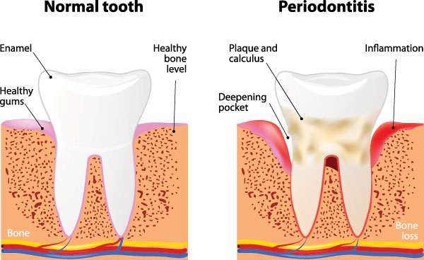 The image is a medical illustration showing different stages of gum disease progression from normal teeth to severe periodontitis, highlighting inflammation, plaque buildup, and bone loss around the teeth.