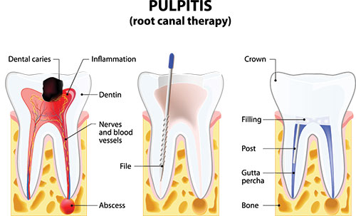 The image displays a detailed diagrammatic illustration of a human tooth structure labeled  Pulpitis  with annotations indicating various parts such as dentin, pulp chamber, and blood vessels, along with arrows pointing to different areas highlighting the process of pulpitis.