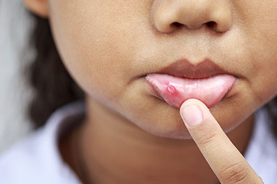 A young girl with her finger on her lips, displaying a small sore or lesion near her mouth, against a blurred background.
