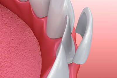 The image shows a close-up view of a dental implant with a pink gum tissue background, featuring a realistic 3D rendering of a patient s mouth and teeth.