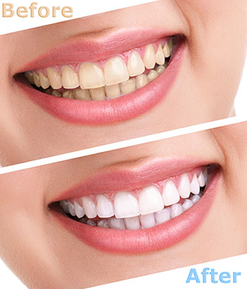 The image shows a before-and-after comparison of teeth whitening, with the top half showing yellowed teeth and the bottom half showing bright white teeth after treatment.
