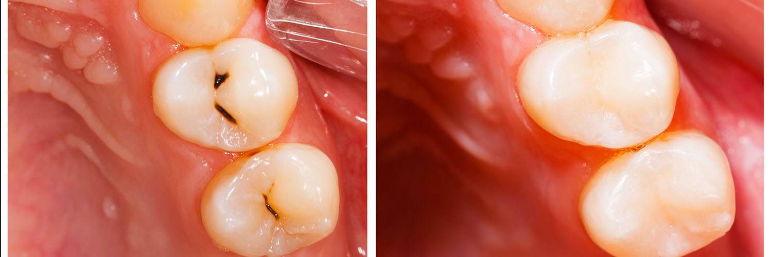 The image shows a close-up view of a mouth with teeth, featuring an area where some teeth have been removed or extracted, with a focus on the gumline and oral cavity.