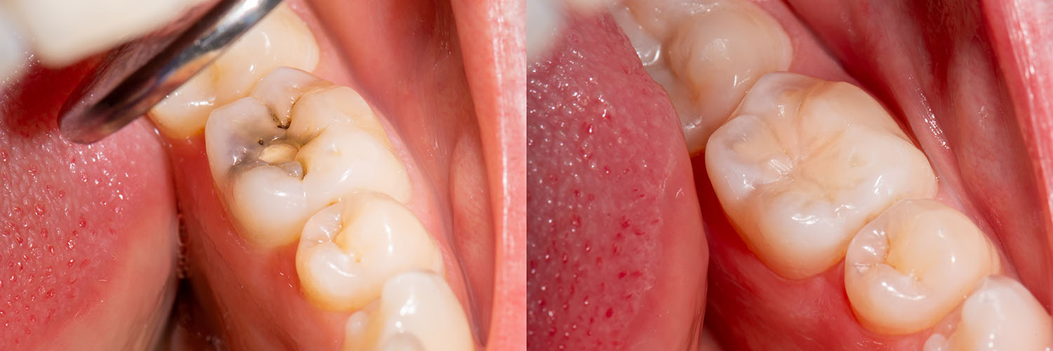 The image shows a close-up view of a dental implant with a screw visible on the side, against a background that appears to be a medical or dental setting.