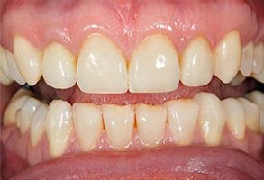 The image shows a close-up view of a person s teeth with yellow stains, indicating potential dental issues such as plaque build-up or tooth decay.