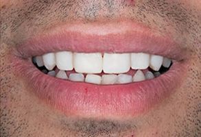 The image displays a close-up of a person s smiling face with a focus on their teeth, which are white and appear to be well-maintained.