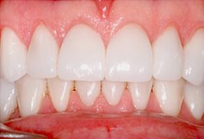 The image displays a close-up view of a person s teeth with a focus on the upper front teeth, which appear to be highly straightened and possibly enhanced cosmetically.