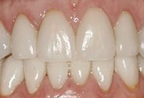 The image shows a close-up of a person s teeth with a focus on a large gap between two front teeth, which appear to be missing or extracted.