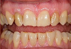 The image displays two photographs of a person s teeth with significant tooth decay, showing the before and after effects of dental treatment, likely highlighting the importance of oral hygiene and professional care.
