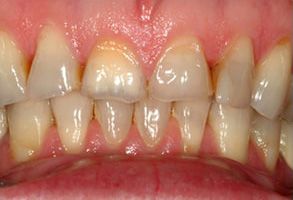 The image shows a close-up view of a person s teeth with visible stains and discoloration.